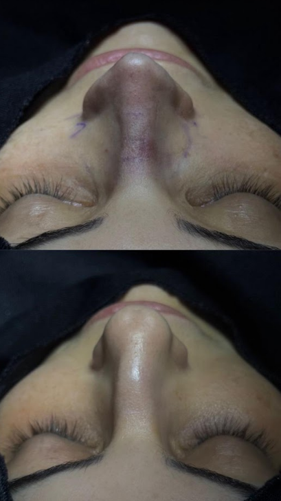 Rinomodelação &Rinoplastia Estética