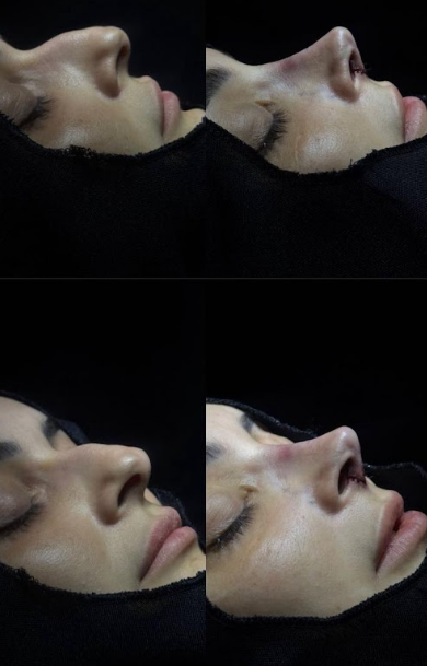 Rinomodelação &Rinoplastia Estética