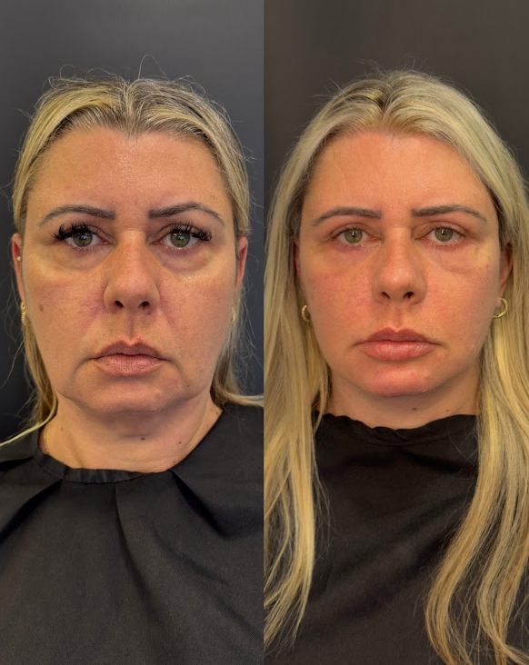 Cirurgias Estéticasda Face & Pálpebras